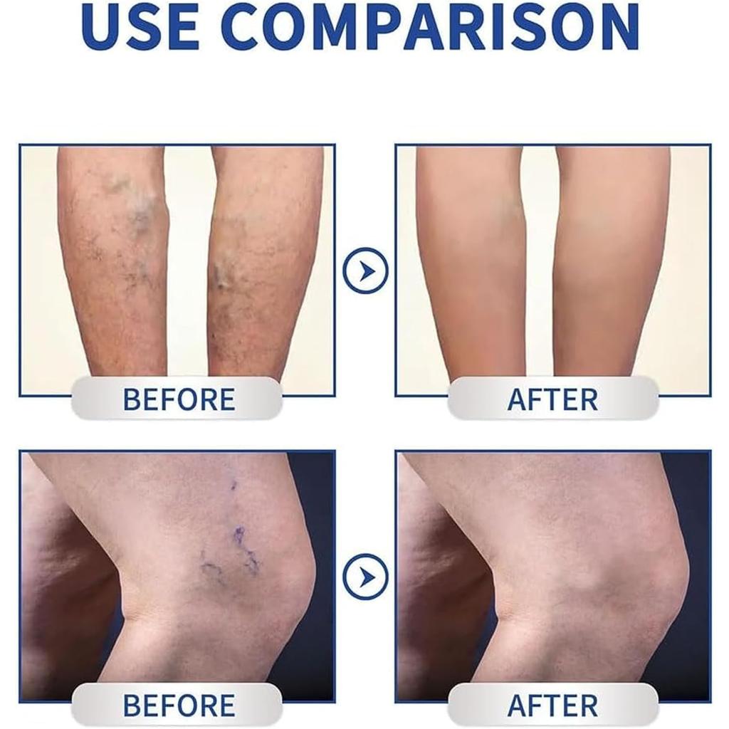 ZENORIA Natural Cream for Varicose Veins, Phlebitis & Spider Veins