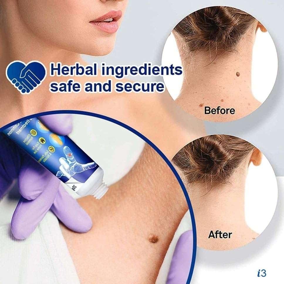 ZENORIA Wart Remover Ointment